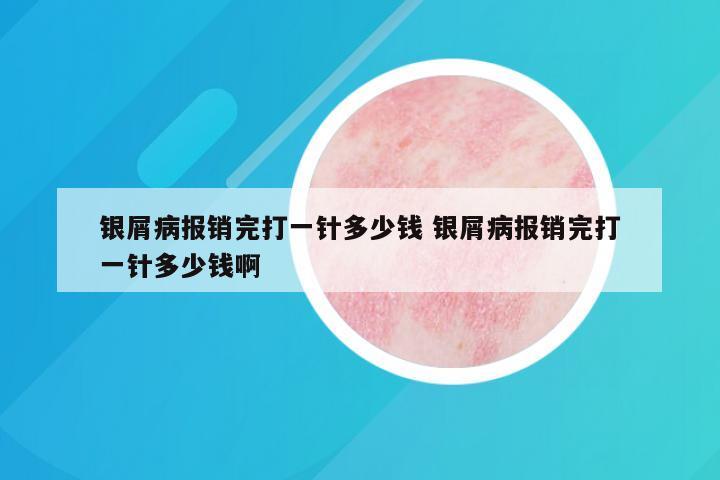 银屑病报销完打一针多少钱 银屑病报销完打一针多少钱啊