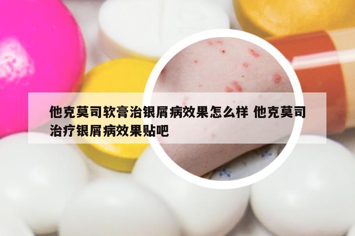 他克莫司软膏治银屑病效果怎么样 他克莫司治疗银屑病效果贴吧
