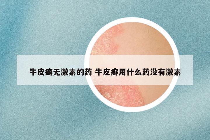 牛皮癣无激素的药 牛皮癣用什么药没有激素