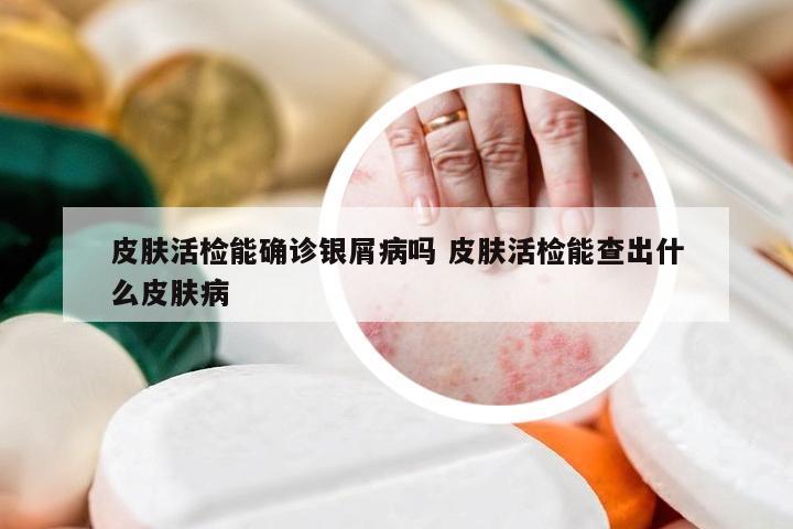 皮肤活检能确诊银屑病吗 皮肤活检能查出什么皮肤病