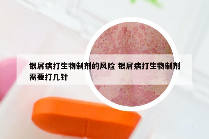 银屑病打生物制剂的风险 银屑病打生物制剂需要打几针