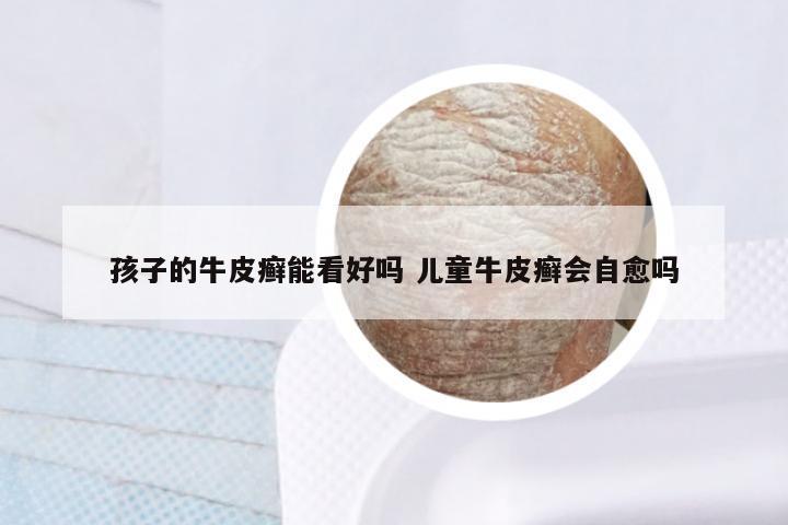 孩子的牛皮癣能看好吗 儿童牛皮癣会自愈吗