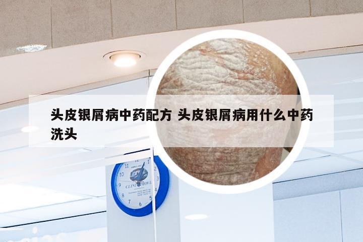 头皮银屑病中药配方 头皮银屑病用什么中药洗头