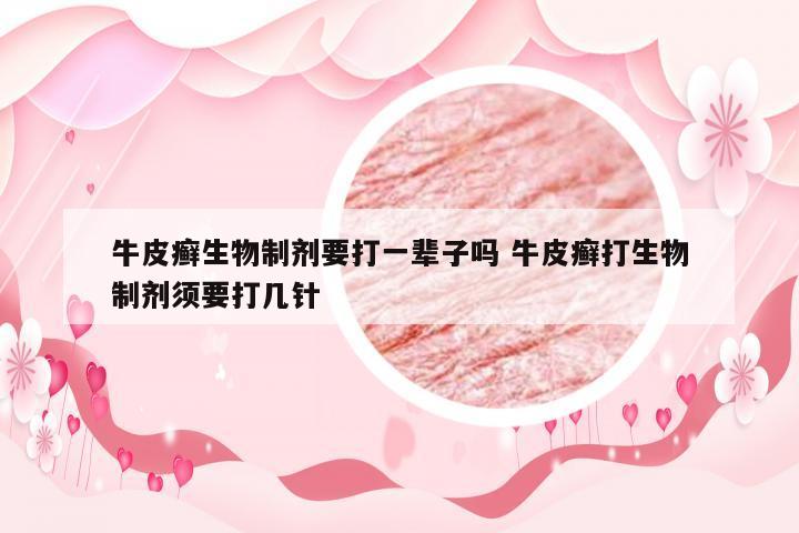 牛皮癣生物制剂要打一辈子吗 牛皮癣打生物制剂须要打几针