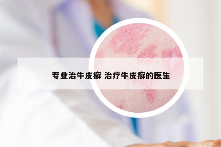 专业治牛皮癣 治疗牛皮癣的医生