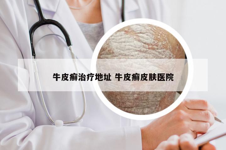 牛皮癣治疗地址 牛皮癣皮肤医院