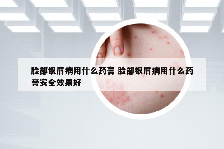 脸部银屑病用什么药膏 脸部银屑病用什么药膏安全效果好