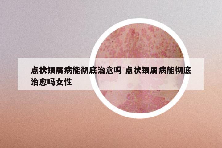 点状银屑病能彻底治愈吗 点状银屑病能彻底治愈吗女性