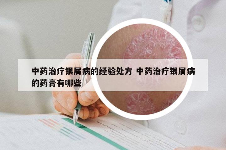 中药治疗银屑病的经验处方 中药治疗银屑病的药膏有哪些