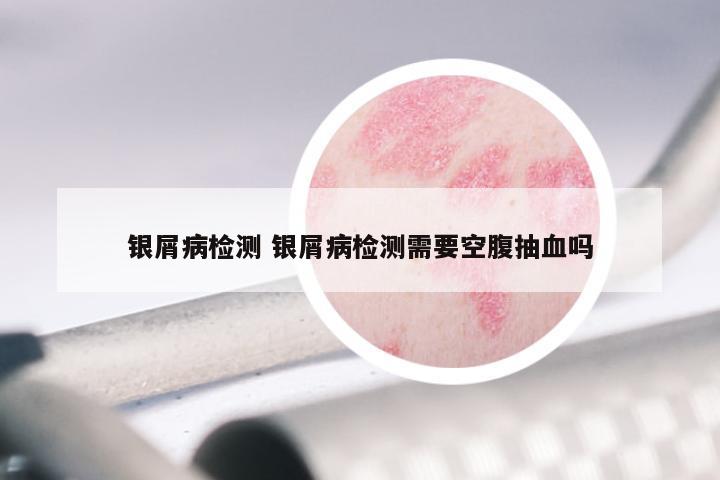 银屑病检测 银屑病检测需要空腹抽血吗