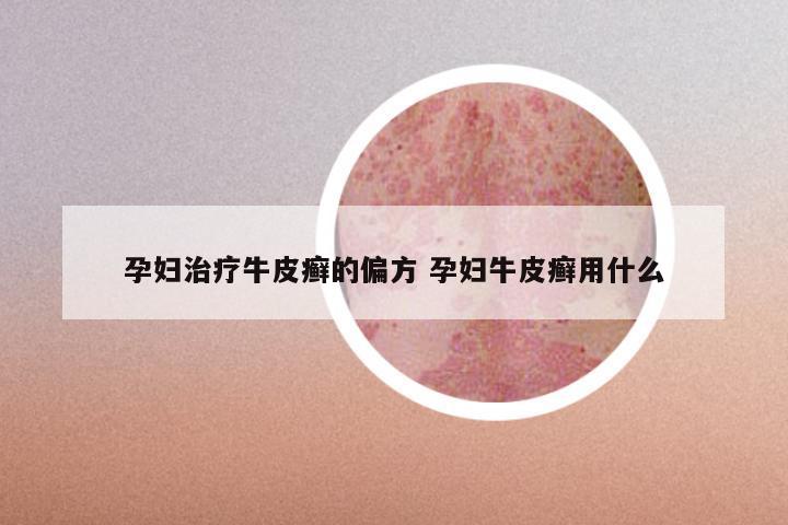 孕妇治疗牛皮癣的偏方 孕妇牛皮癣用什么