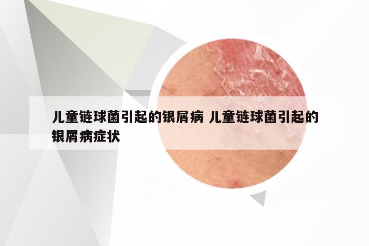 儿童链球菌引起的银屑病 儿童链球菌引起的银屑病症状