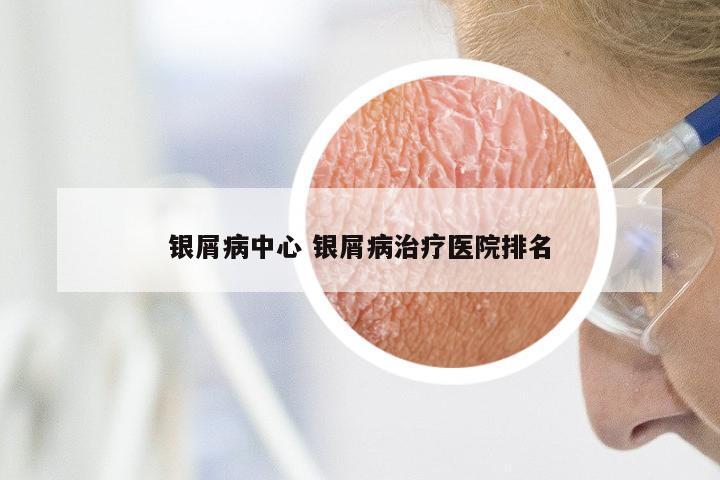 银屑病中心 银屑病治疗医院排名