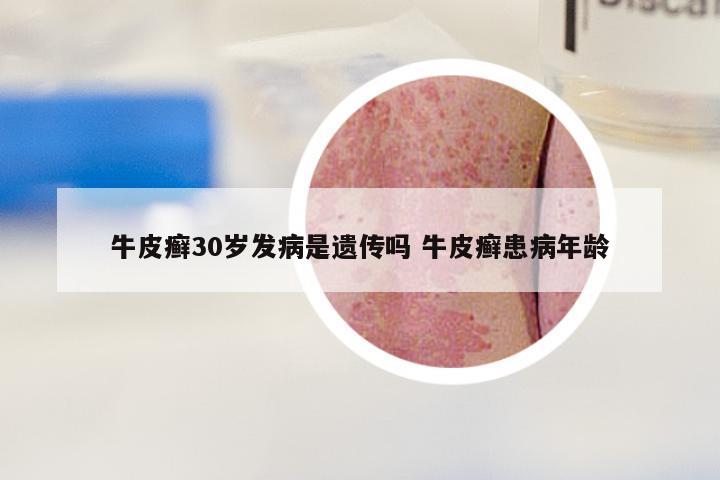 牛皮癣30岁发病是遗传吗 牛皮癣患病年龄