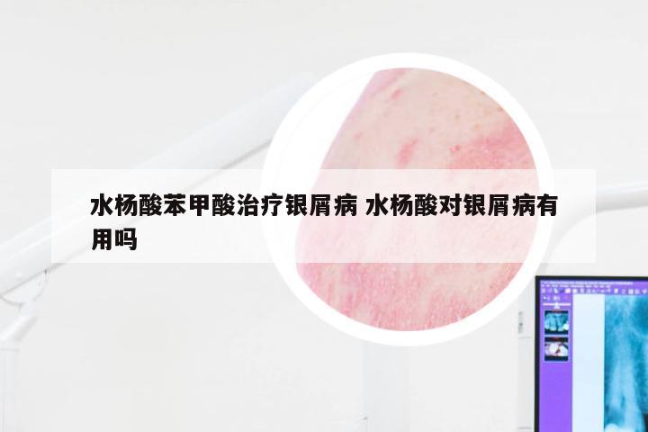 水杨酸苯甲酸治疗银屑病 水杨酸对银屑病有用吗