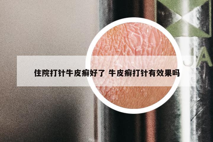 住院打针牛皮癣好了 牛皮癣打针有效果吗
