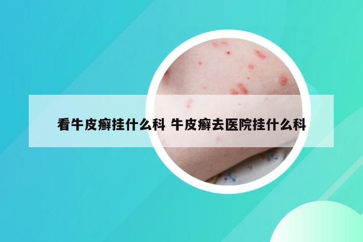 看牛皮癣挂什么科 牛皮癣去医院挂什么科