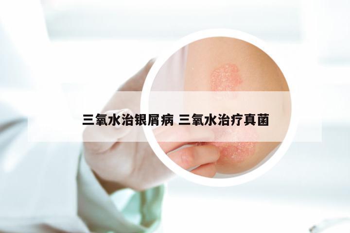 三氧水治银屑病 三氧水治疗真菌
