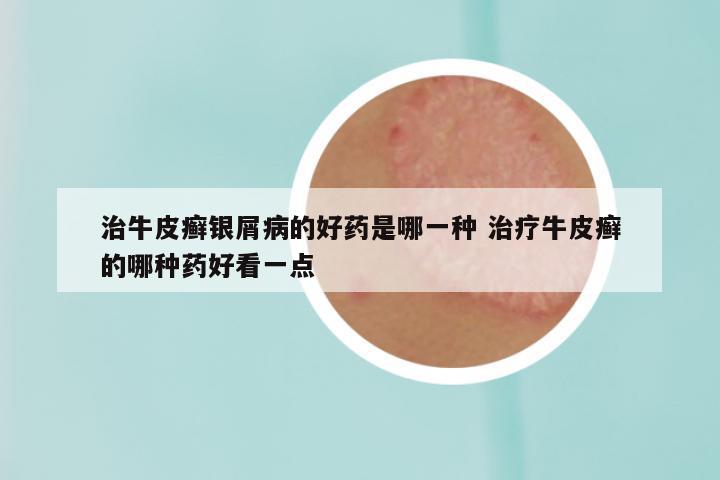 治牛皮癣银屑病的好药是哪一种 治疗牛皮癣的哪种药好看一点