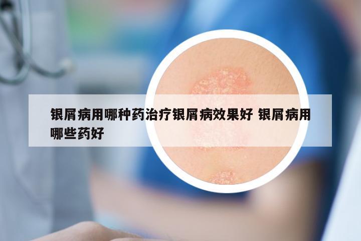 银屑病用哪种药治疗银屑病效果好 银屑病用哪些药好