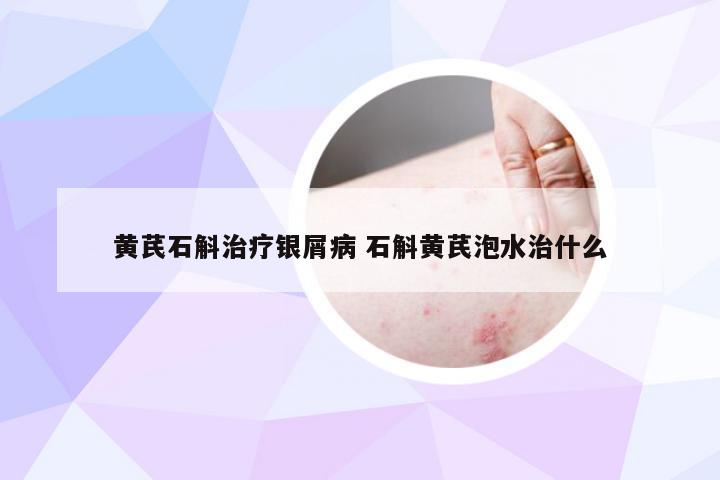 黄芪石斛治疗银屑病 石斛黄芪泡水治什么