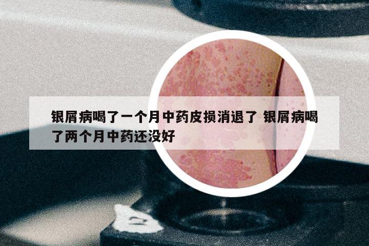 银屑病喝了一个月中药皮损消退了 银屑病喝了两个月中药还没好