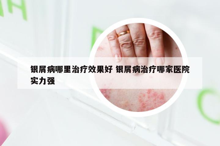 银屑病哪里治疗效果好 银屑病治疗哪家医院实力强