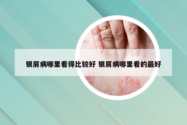 银屑病哪里看得比较好 银屑病哪里看的最好