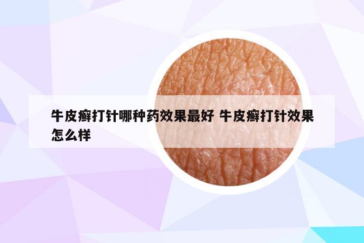 牛皮癣打针哪种药效果最好 牛皮癣打针效果怎么样