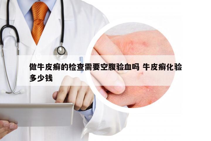 做牛皮癣的检查需要空腹验血吗 牛皮癣化验多少钱