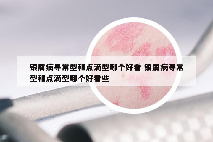 银屑病寻常型和点滴型哪个好看 银屑病寻常型和点滴型哪个好看些