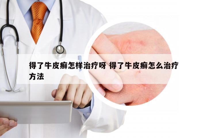 得了牛皮癣怎样治疗呀 得了牛皮癣怎么治疗方法