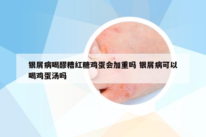 银屑病喝醪糟红糖鸡蛋会加重吗 银屑病可以喝鸡蛋汤吗