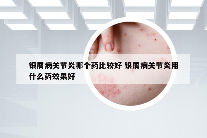 银屑病关节炎哪个药比较好 银屑病关节炎用什么药效果好
