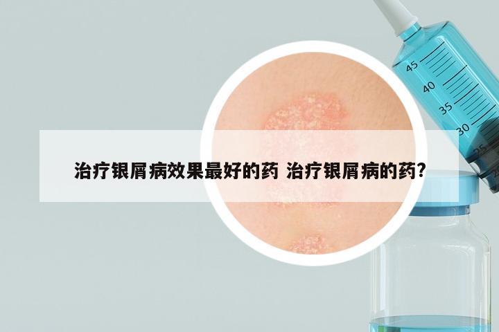 治疗银屑病效果最好的药 治疗银屑病的药?