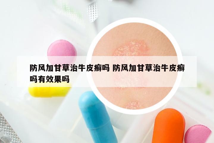 防风加甘草治牛皮癣吗 防风加甘草治牛皮癣吗有效果吗