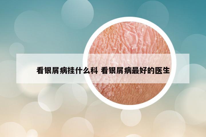 看银屑病挂什么科 看银屑病最好的医生