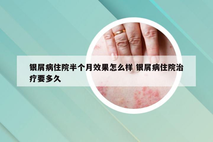 银屑病住院半个月效果怎么样 银屑病住院治疗要多久