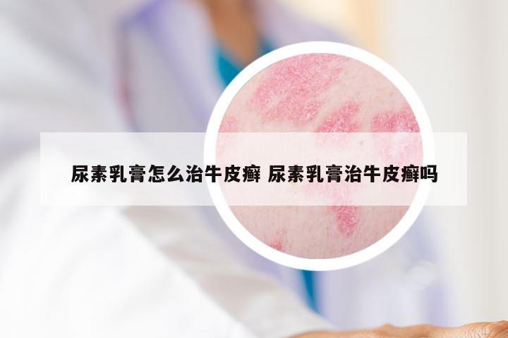 尿素乳膏怎么治牛皮癣 尿素乳膏治牛皮癣吗