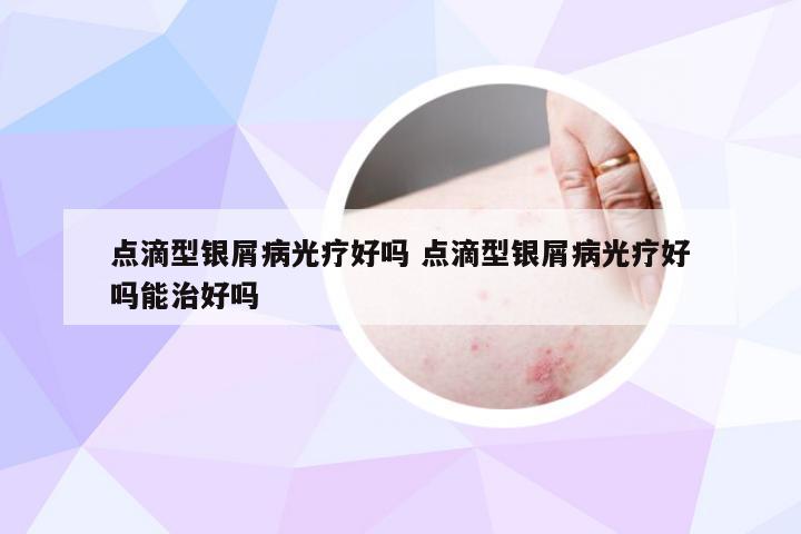 点滴型银屑病光疗好吗 点滴型银屑病光疗好吗能治好吗