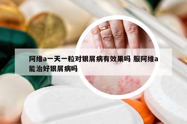 阿维a一天一粒对银屑病有效果吗 服阿维a能治好银屑病吗