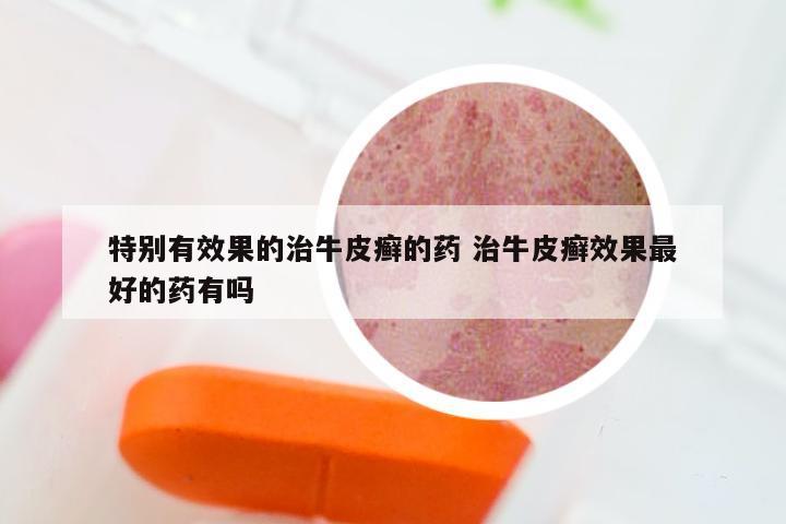 特别有效果的治牛皮癣的药 治牛皮癣效果最好的药有吗
