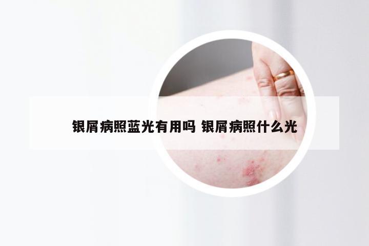 银屑病照蓝光有用吗 银屑病照什么光