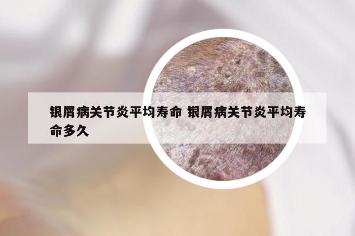 银屑病关节炎平均寿命 银屑病关节炎平均寿命多久