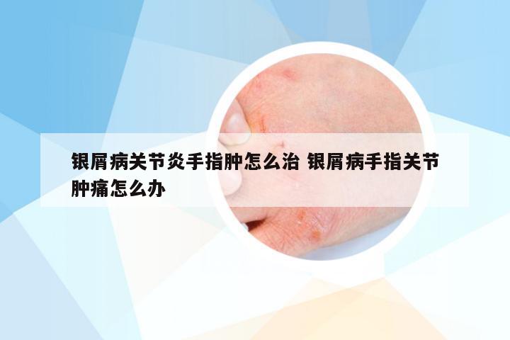 银屑病关节炎手指肿怎么治 银屑病手指关节肿痛怎么办