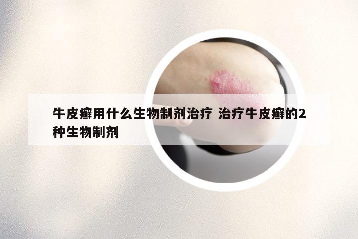 牛皮癣用什么生物制剂治疗 治疗牛皮癣的2种生物制剂