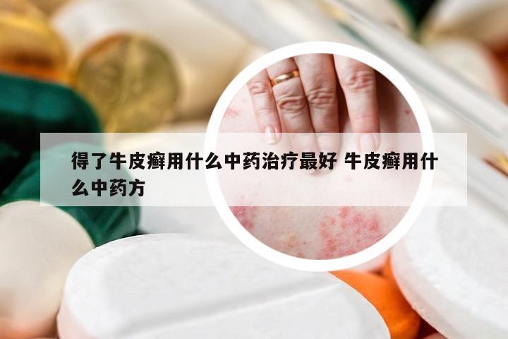 得了牛皮癣用什么中药治疗最好 牛皮癣用什么中药方