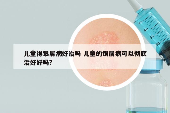 儿童得银屑病好治吗 儿童的银屑病可以彻底治好好吗?