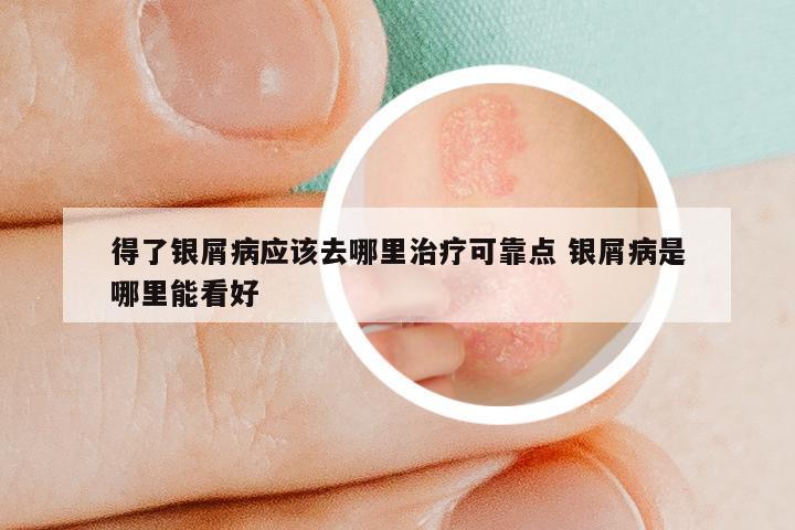 得了银屑病应该去哪里治疗可靠点 银屑病是哪里能看好