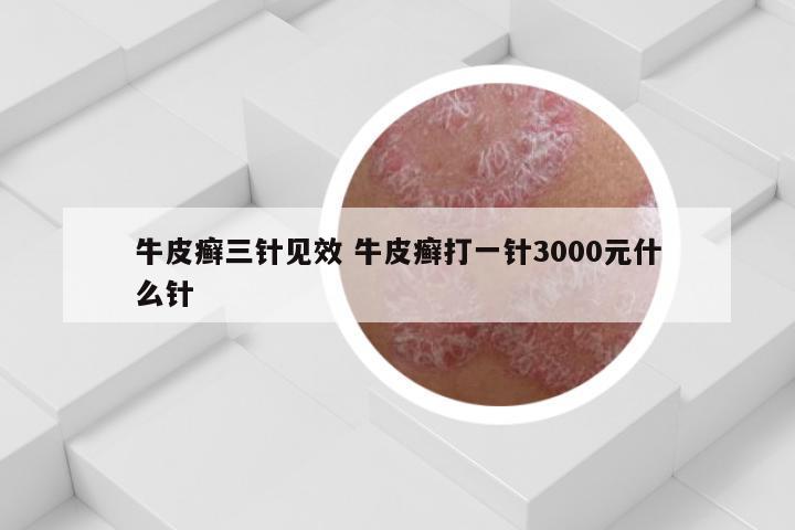 牛皮癣三针见效 牛皮癣打一针3000元什么针
